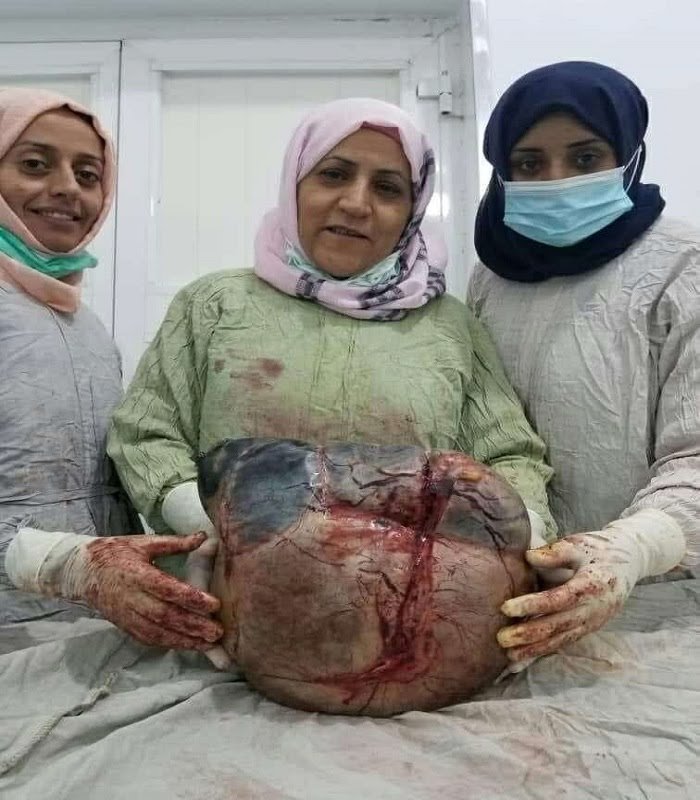 إستئصال ورم يزن 10 كيلو جرام من رحم سيدة في صنعاء-صورة